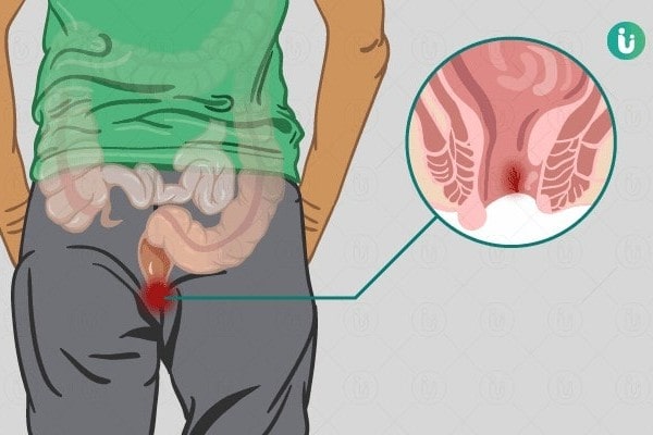 Anal Fissure Surgery Treatment in Bibwewadi, Pune by Dr. Rutik Gandhi