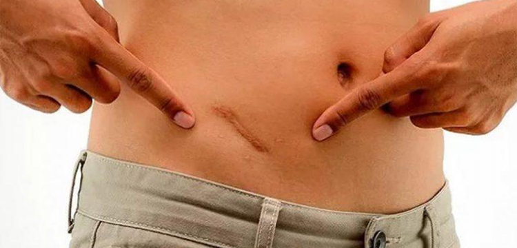 Appendix Treatment in Bibwewadi, Pune by Dr. Rutik Gandhi