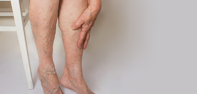 Varicose Vein Treatment in Bibwewadi, Pune by Dr. Rutik Gandhi