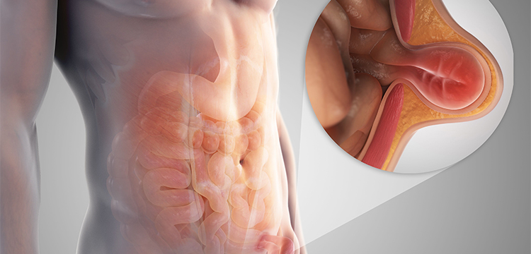 Hernia Treatment in Bibwewadi, Pune by Dr. Rutik Gandhi